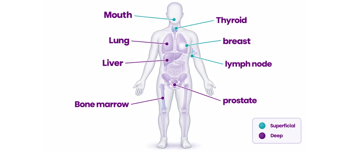 Wide body map marking common biopsy sites, breast to prostate - CION Cancer Clinics