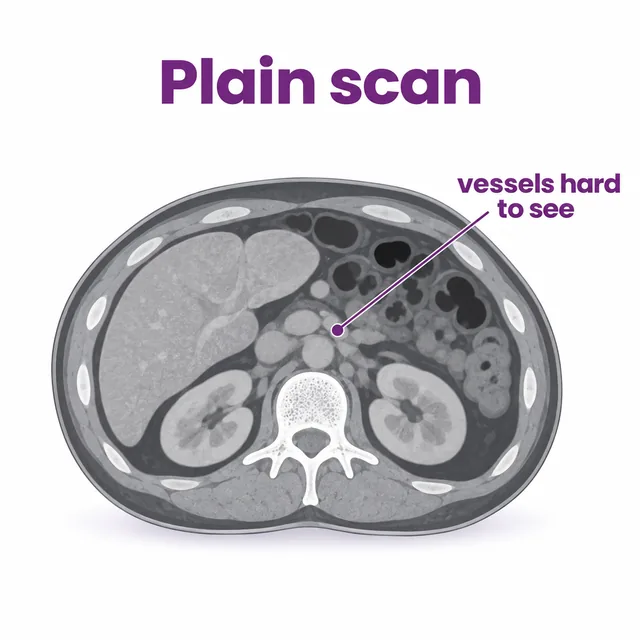 Diagram of a plain CT scan slice where blood vessels and soft tissues are hard to distinguish - CION Cancer Clinics