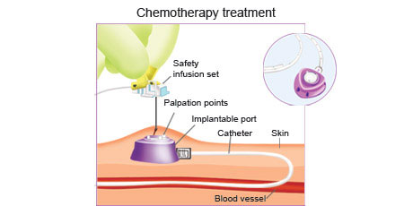 Chemo3