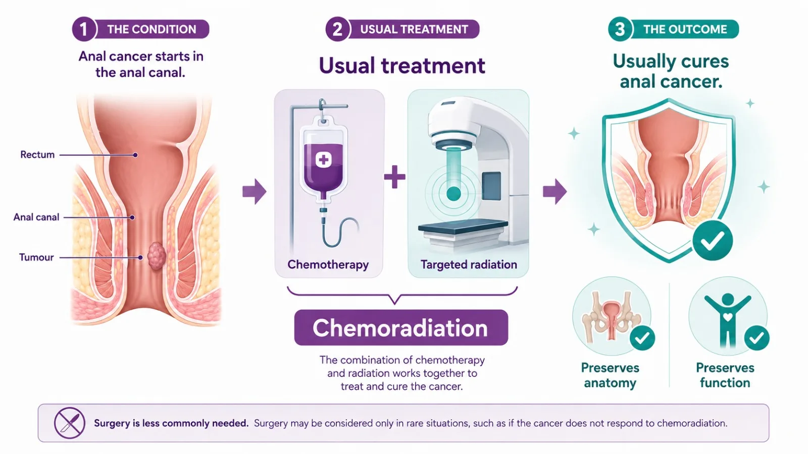 Chemoradiation as organ-preserving treatment for anal cancer - CION Cancer Clinics