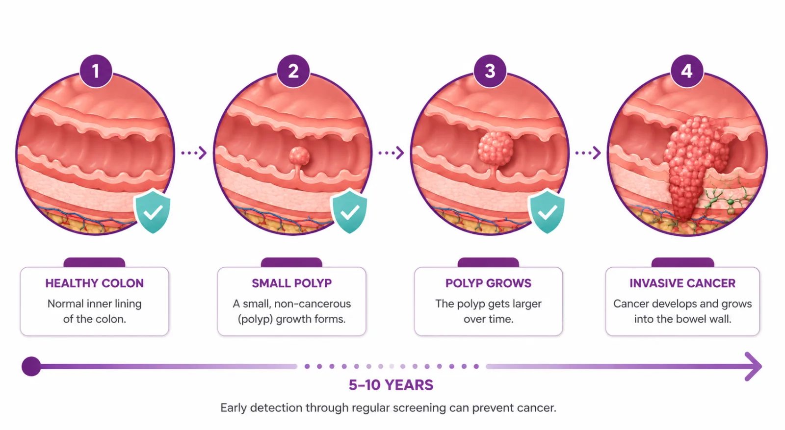 Illustration of how a colon polyp slowly develops into colon cancer over 5 to 10 years