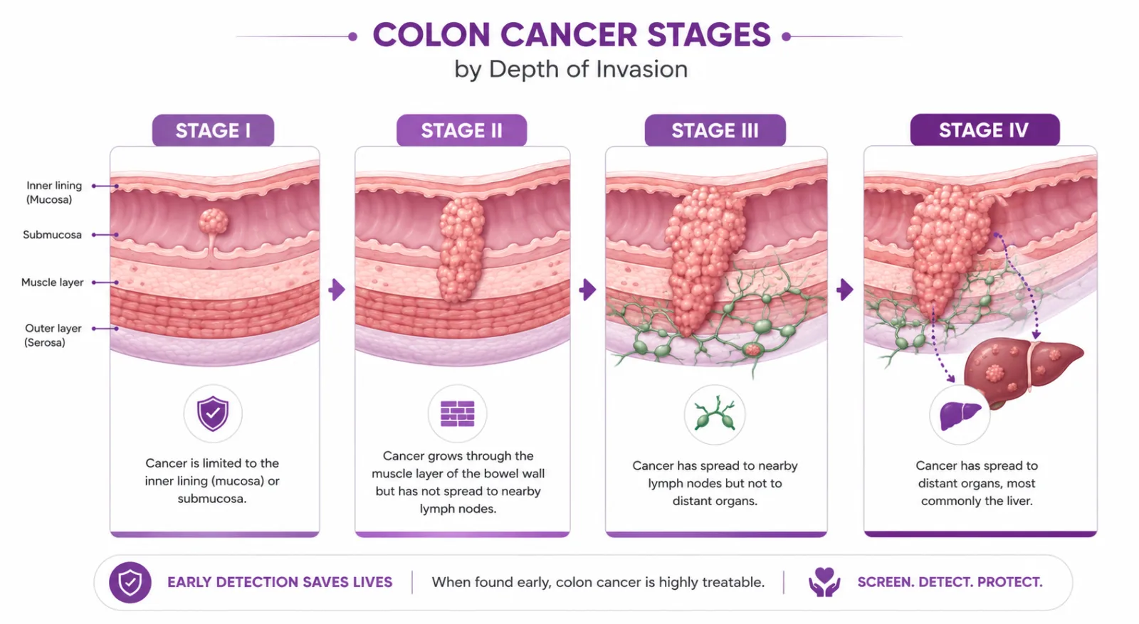 Illustration of colon cancer stages by depth of invasion - CION Cancer Clinics, Hyderabad