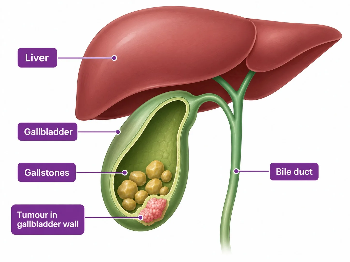Labelled gallbladder anatomy showing gallstones and cancer - CION Cancer Clinics