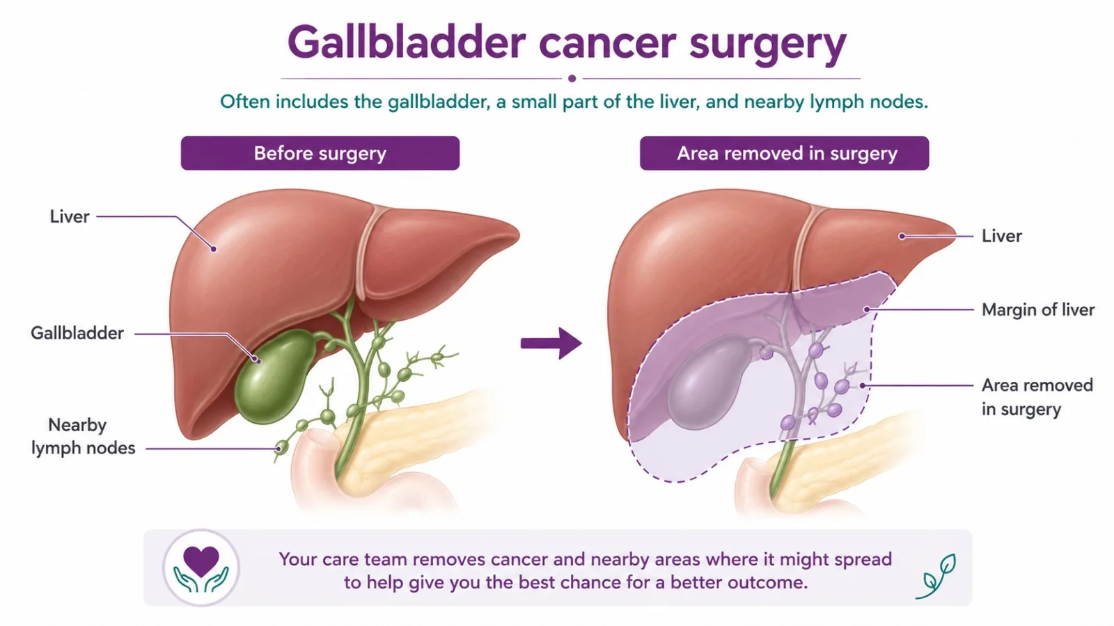 Extended cholecystectomy for gallbladder cancer - CION Cancer Clinics