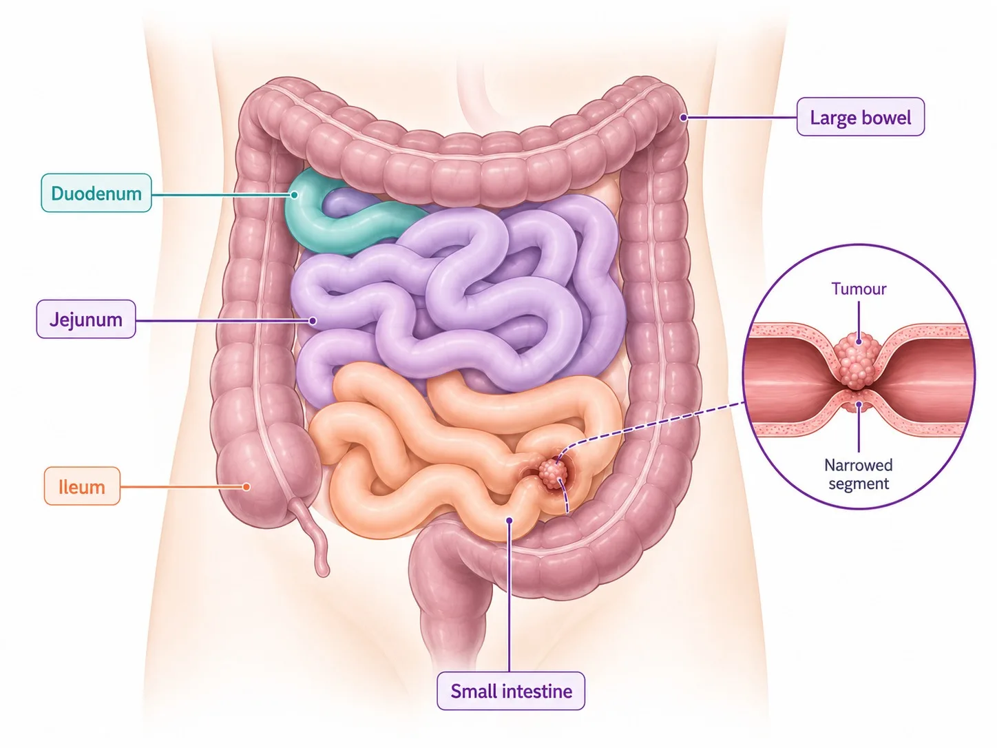 Labelled small intestine anatomy distinct from the colon - CION Cancer Clinics
