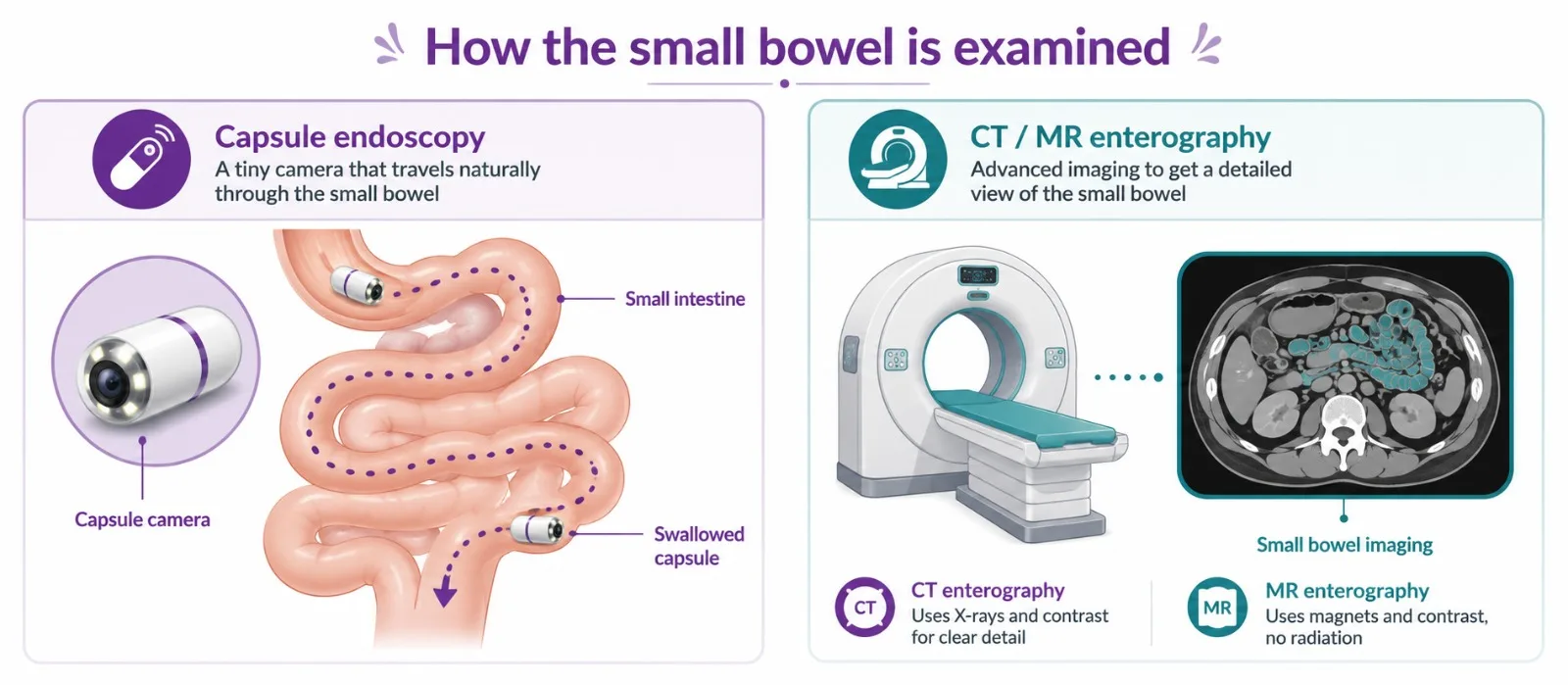 Capsule endoscopy and enterography for small intestine cancer - CION Cancer Clinics