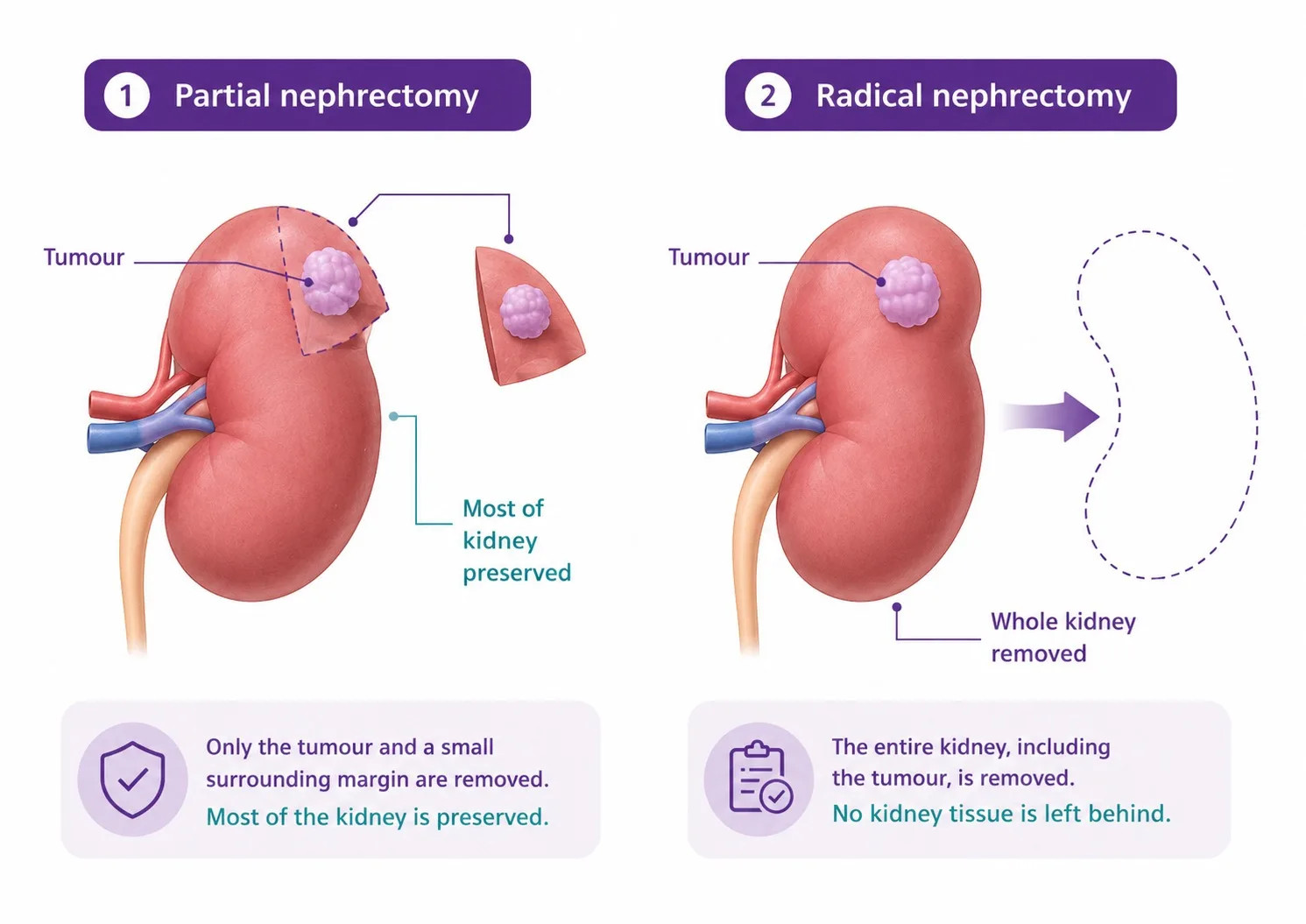 Partial versus radical nephrectomy for kidney cancer - CION Cancer Clinics