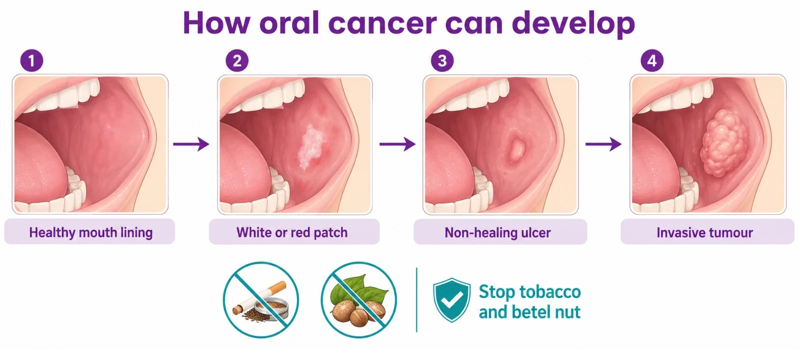 Illustration of how tobacco and betel nut lead to oral cancer - CION Cancer Clinics