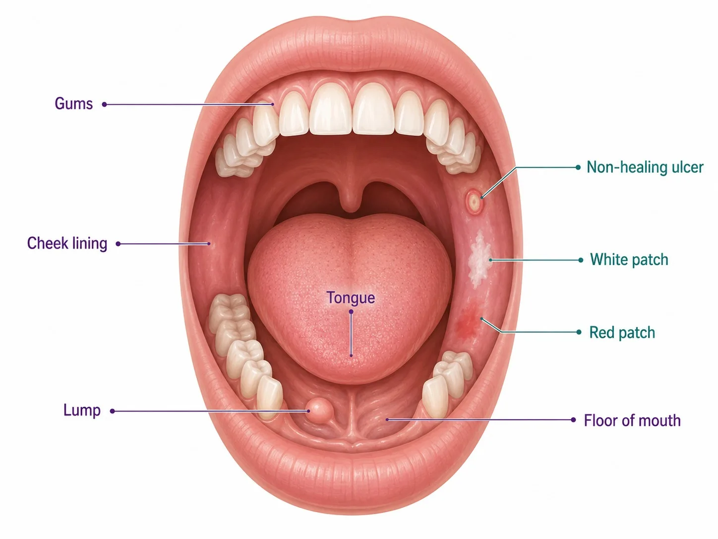 Guide to recognising oral cancer warning signs in the mouth - CION Cancer Clinics