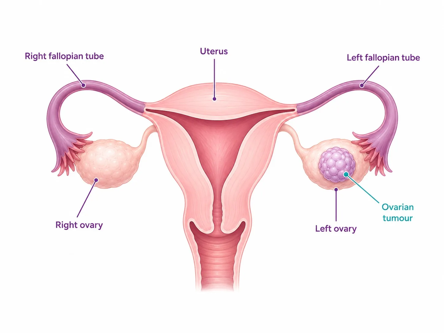 Labelled anatomy of the ovaries showing where ovarian cancer develops - CION Cancer Clinics