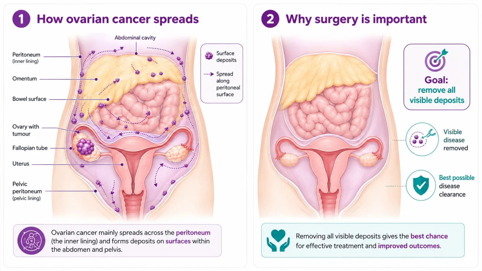 Illustration of how ovarian cancer spreads in the abdomen - CION Cancer Clinics