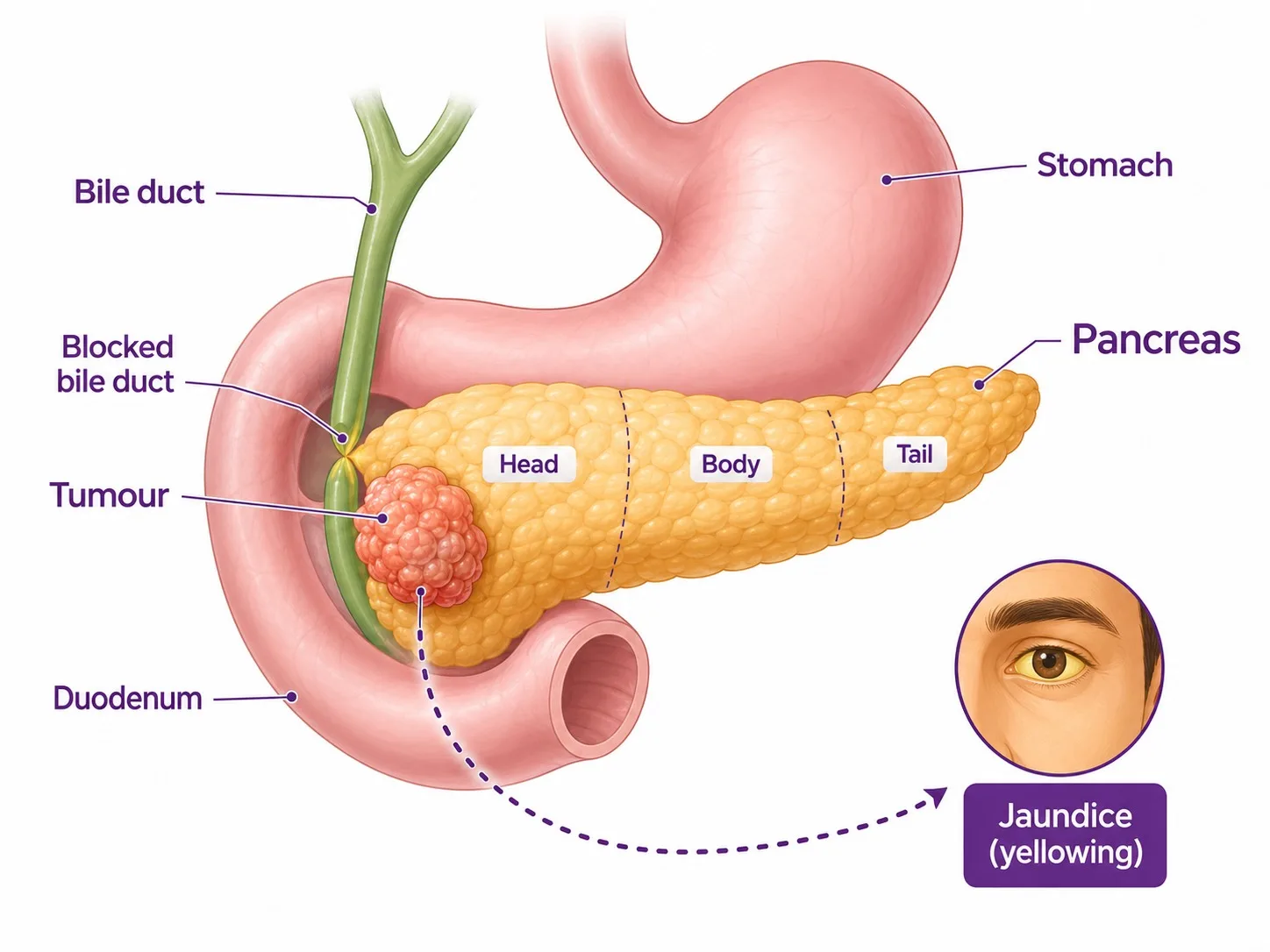 Labelled pancreas anatomy showing how a head tumour causes jaundice - CION Cancer Clinics