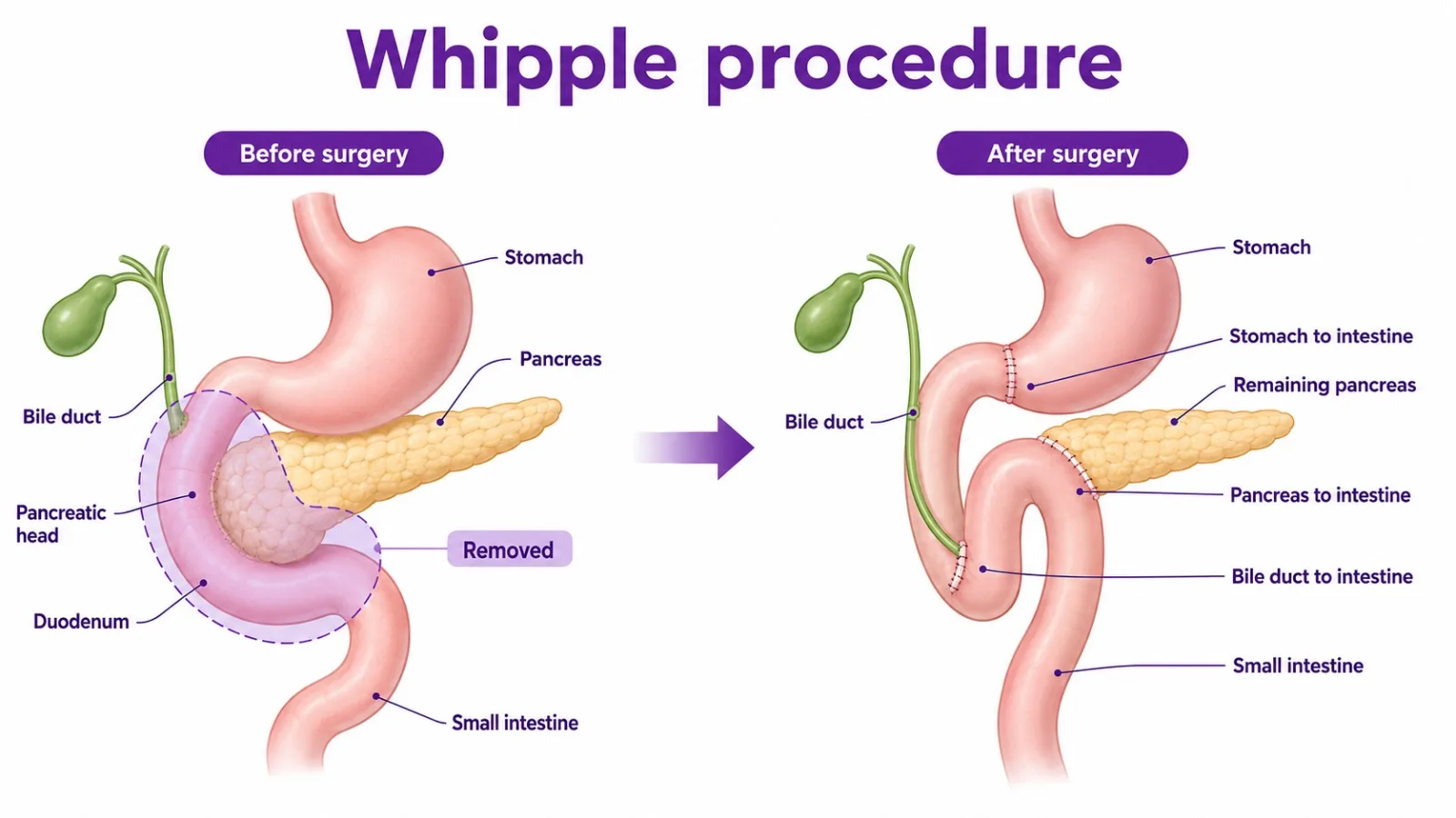Diagram of the Whipple procedure for pancreatic cancer - CION Cancer Clinics