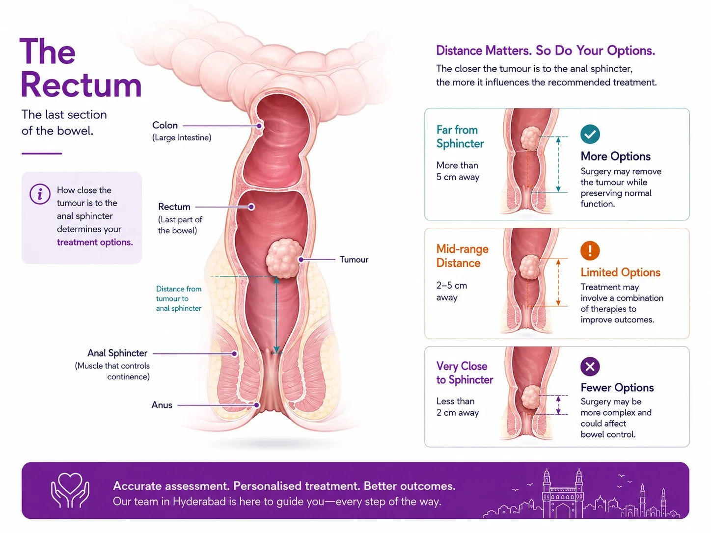 Rectal anatomy showing tumour distance from the anal sphincter - CION Cancer Clinics