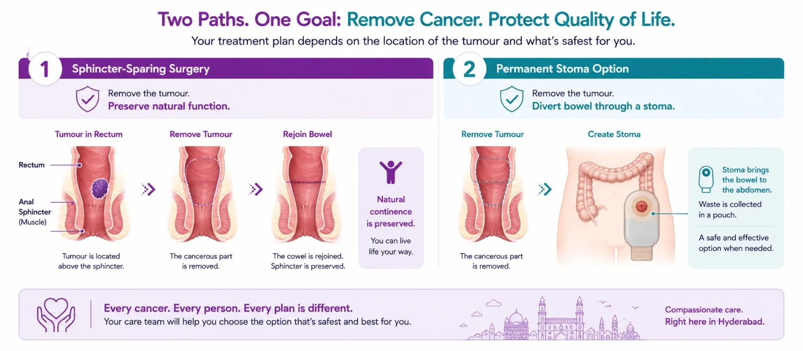 Sphincter-sparing surgery for rectal cancer - CION Cancer Clinics