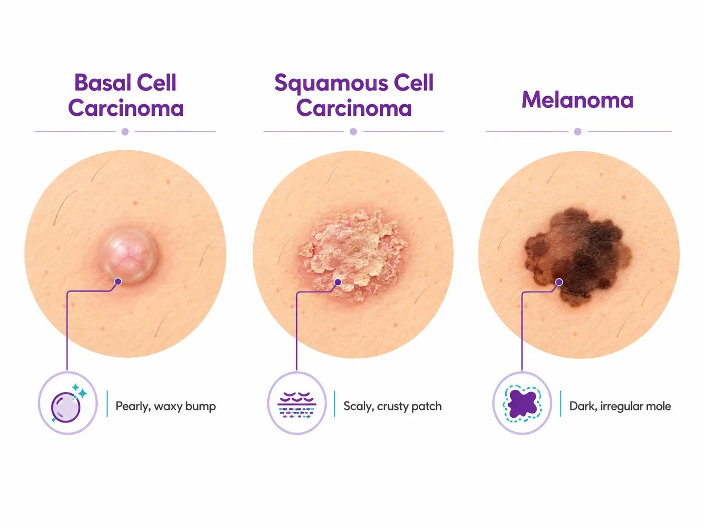 Comparison of basal cell, squamous cell and melanoma skin cancers - CION Cancer Clinics