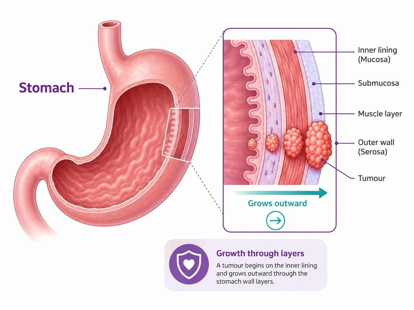 Labelled stomach anatomy showing how stomach cancer grows through the wall - CION Cancer Clinics