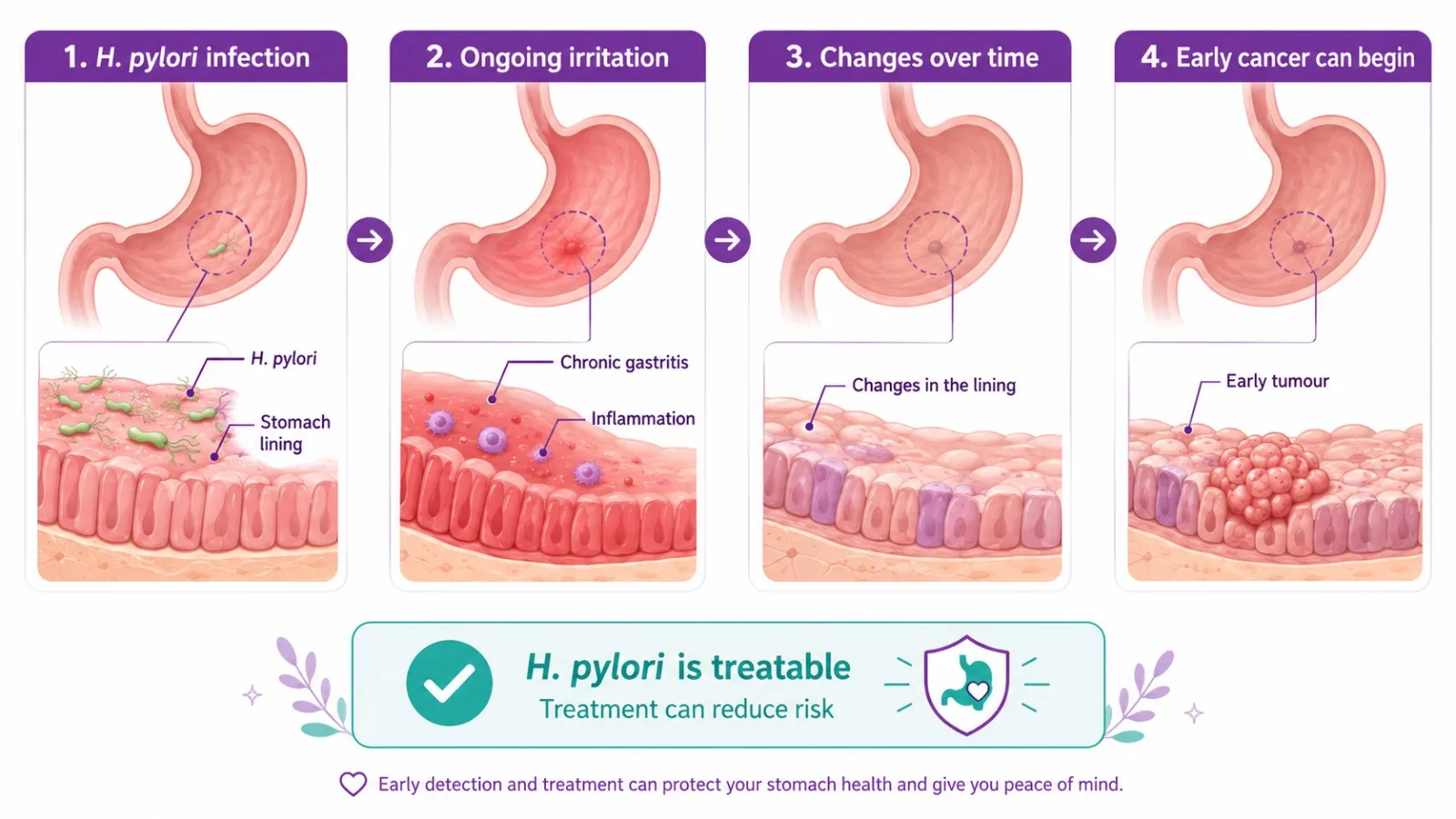 Illustration of how H. pylori infection can lead to stomach cancer - CION Cancer Clinics