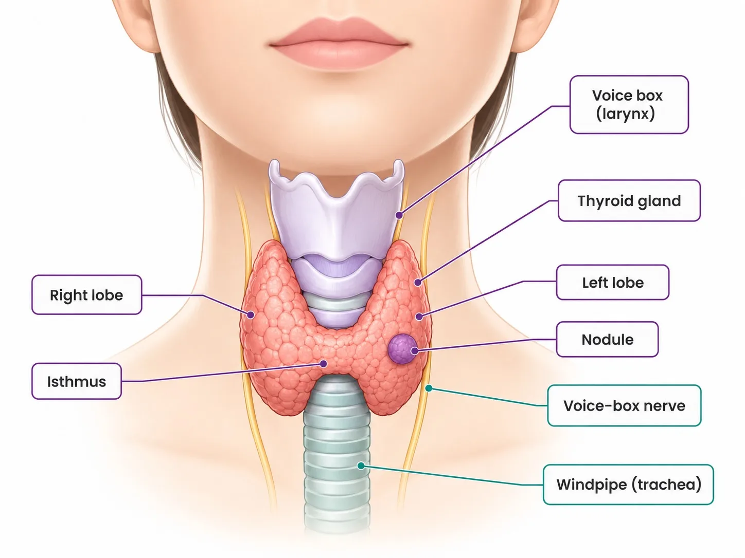 Labelled thyroid anatomy in the neck showing a thyroid nodule - CION Cancer Clinics